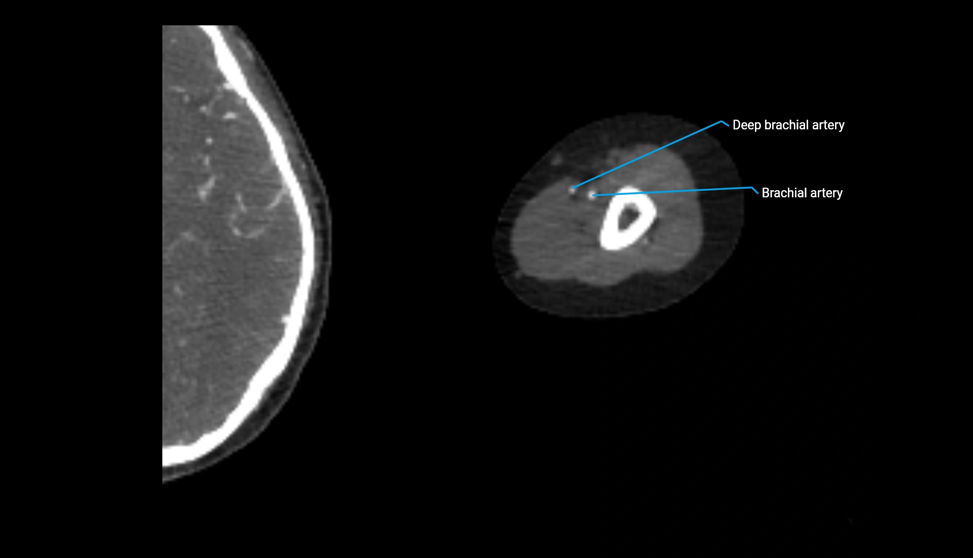 CTA upper limb axial cross sectional anatomy labelled image 246 (2).webp